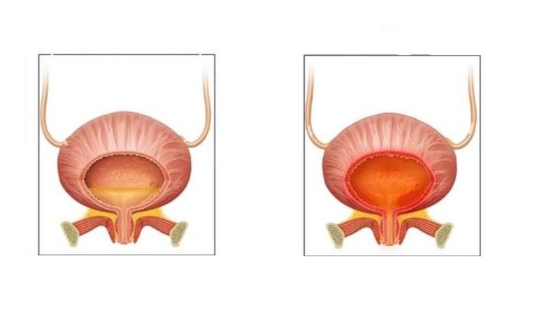 Normal e pacientes con cistite do tracto urinario