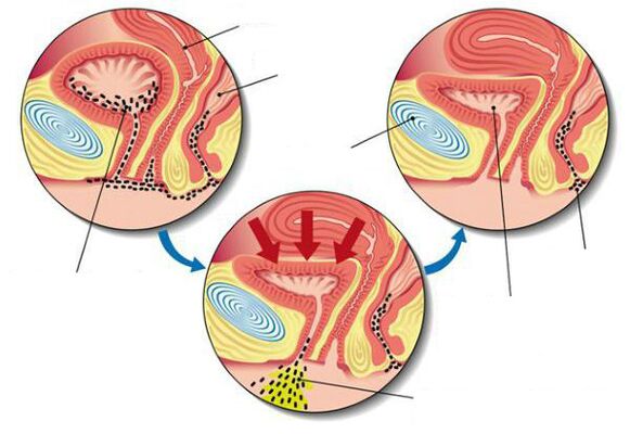 bacterias na vexiga con cistite