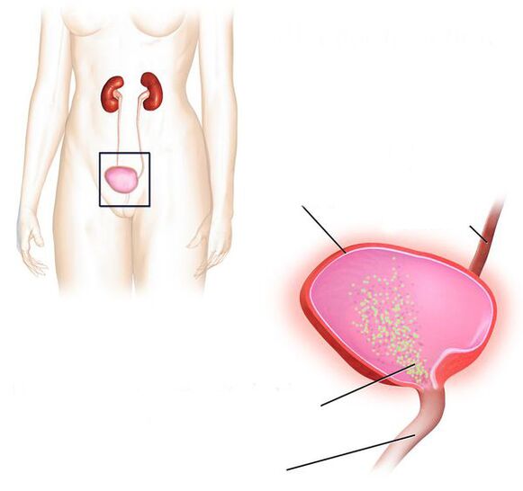 inflamación da vexiga